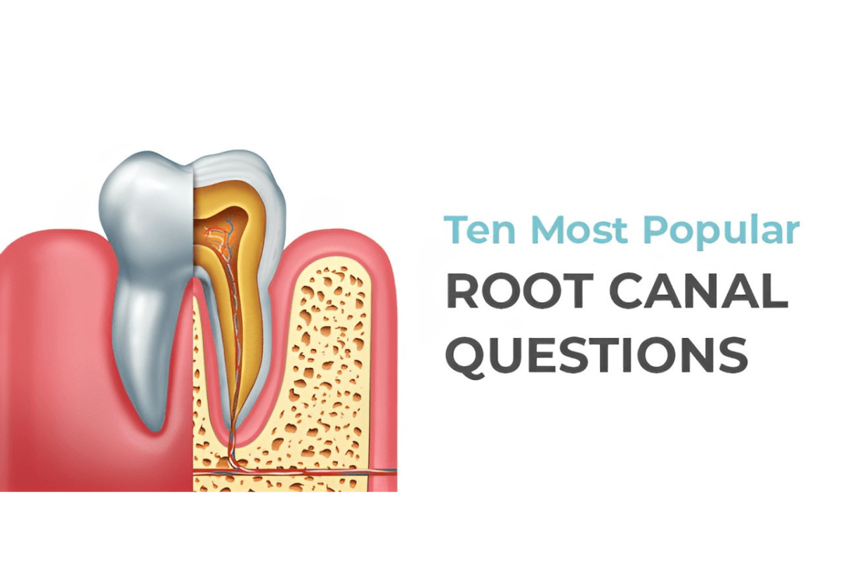most common questions about root canal